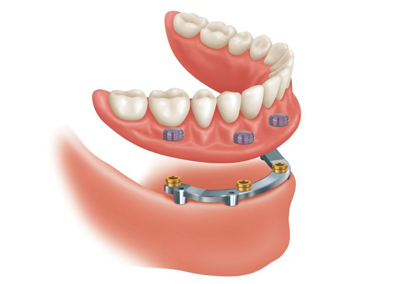 Протезирование зубов инвалиду 1 группы. Протез на 2 имплантах на нижнюю челюсть. Покрывные зубные протезы. Покрывной протез зубов на имплантах.
